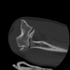 SPORK, NICO - 22.03.1976 - 02.08.2022 - CT obere Extremität - 17:59:38